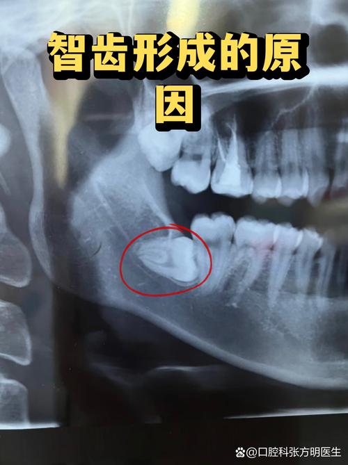 由于現代人頜骨空間不足,很多智齒無法正常生長,導致各種口腔問題